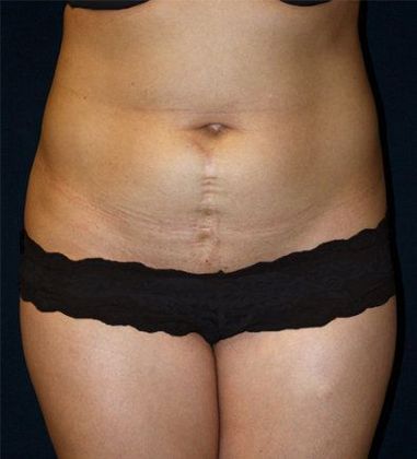 Tummy Tuck*: Case 14 - Front Before