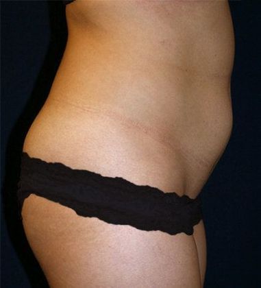 Tummy Tuck*: Case 14 - Side Before