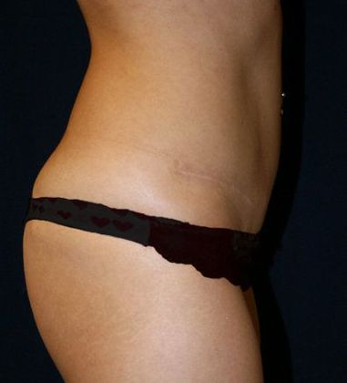Tummy Tuck*: Case 14 - Side After