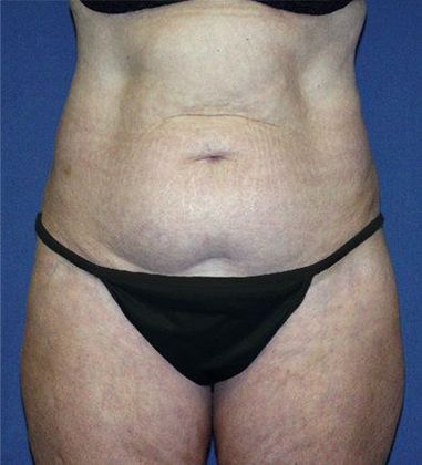 Tummy Tuck*: Case 12 - Front Before
