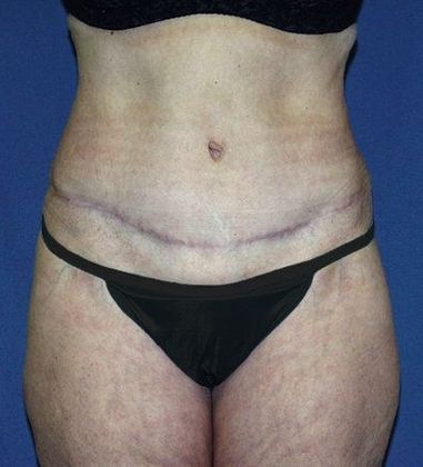 Tummy Tuck*: Case 12 - Front After