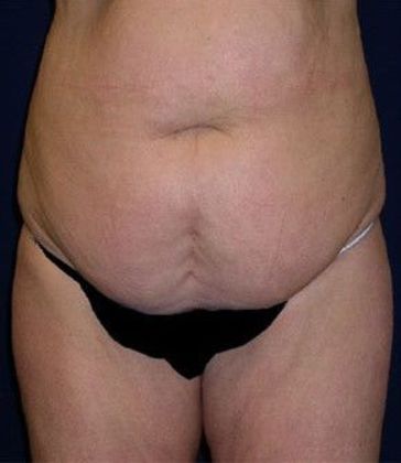 Tummy Tuck*: Case 13 - Front Before