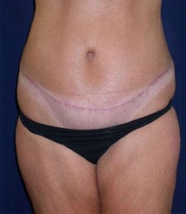 Tummy Tuck*: Case 13 - Front After