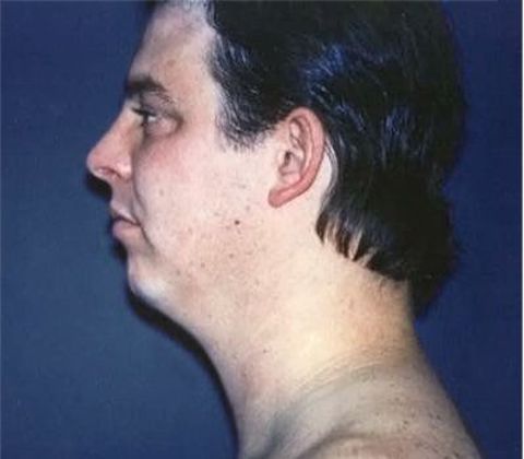 Chin Augmentation*: Case 1 - Side Before