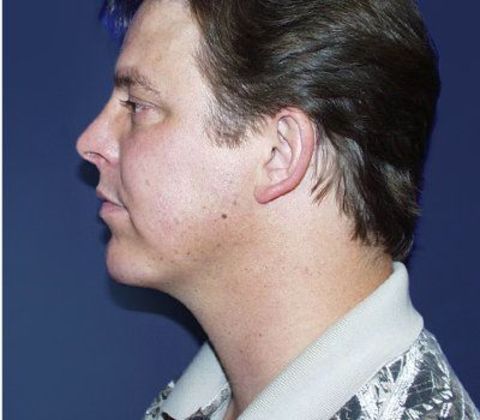 Chin Augmentation*: Case 1 - Side After