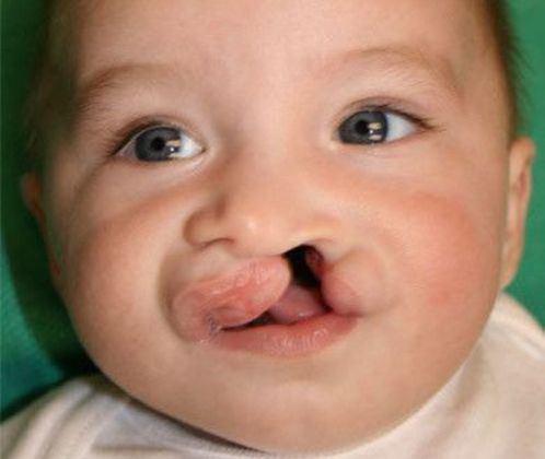 Cleft Lip*: Case 1 - Before