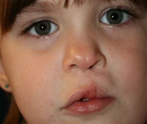 Cleft Lip*: Case 1 - After