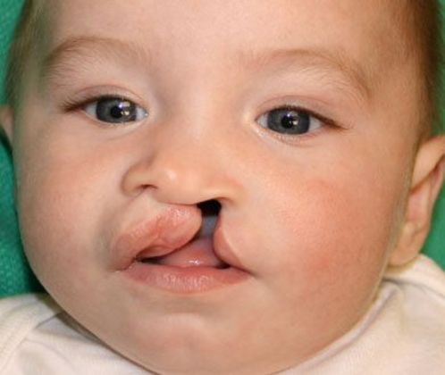 Cleft Lip*: Case 1 - Before