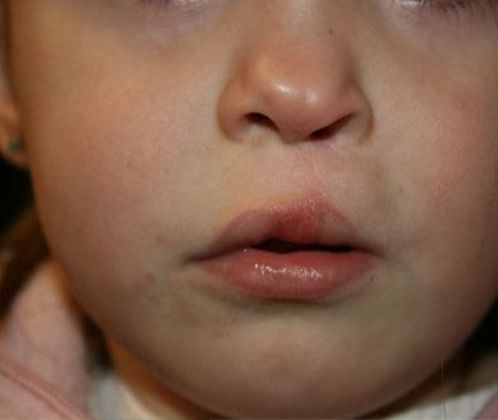 Cleft Lip*: Case 1 - After
