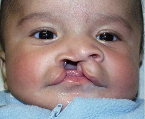 Cleft Lip*: Case 2 - Before