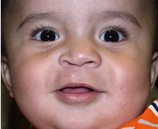 Cleft Lip*: Case 2 - After