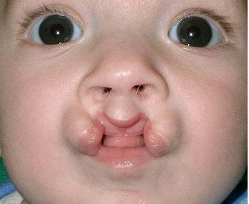 Cleft Lip*: Case 3 - Before