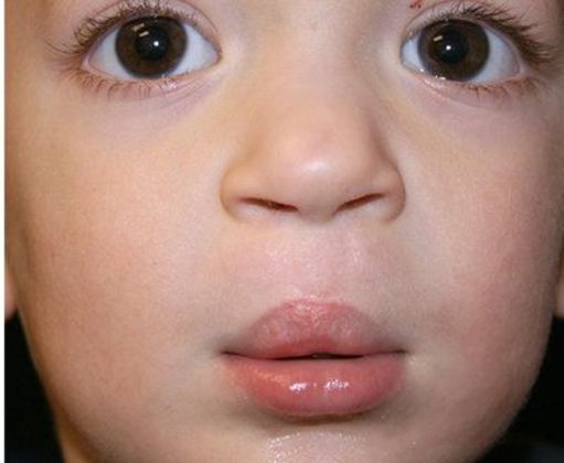 Cleft Lip*: Case 3 - After