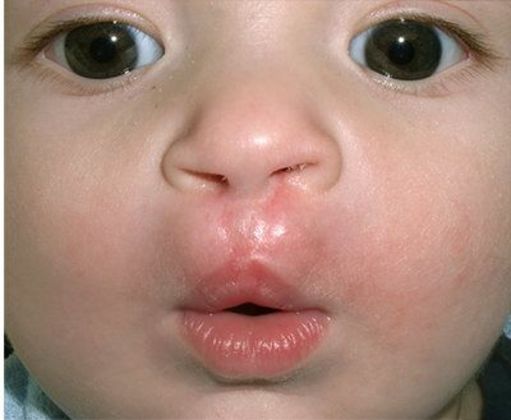 Cleft Lip*: Case 3 - After