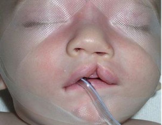 Cleft Lip*: Case 4 - Before