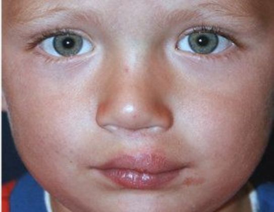 Cleft Lip*: Case 4 - After