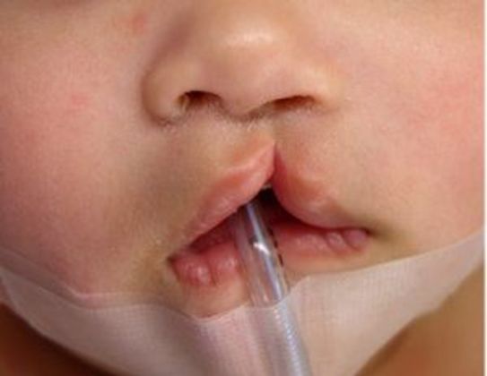 Cleft Lip*: Case 4 - Before