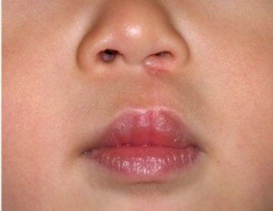 Cleft Lip*: Case 4 - After
