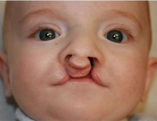 Cleft Lip*: Case 5 - Before