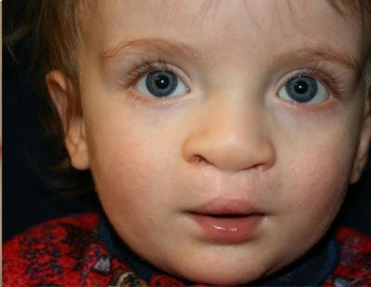 Cleft Lip*: Case 5 - After