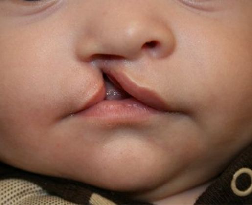 Cleft Lip*: Case 6 - Before