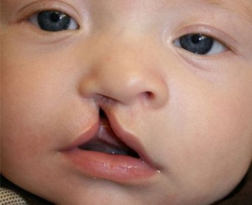 Cleft Lip*: Case 6 - Before