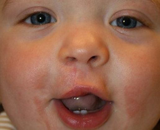 Cleft Lip*: Case 6 - After