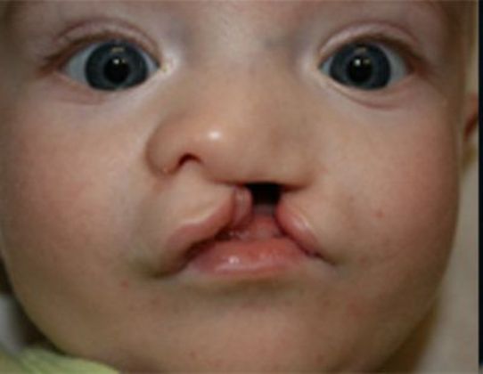 Cleft Lip*: Case 7 - Before