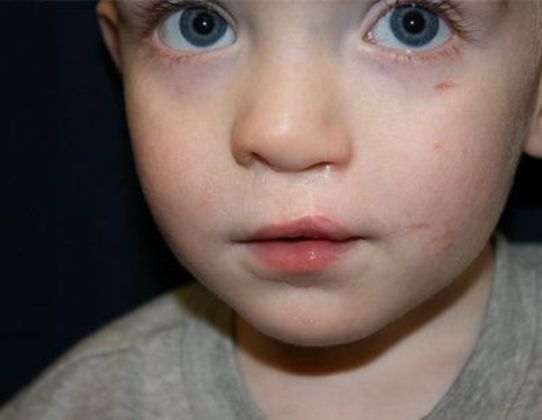 Cleft Lip*: Case 7 - After