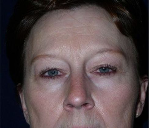 Eye Lift*: Case 2 - Front Before