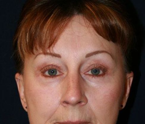 Eye Lift*: Case 2 - Front After