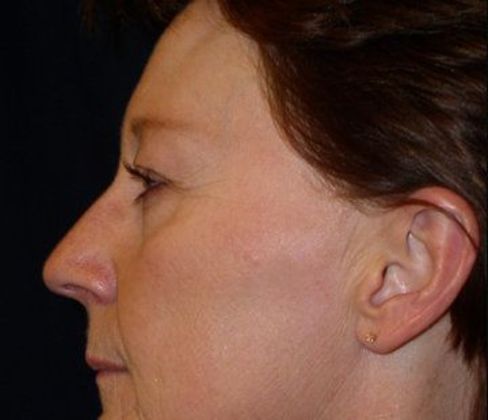 Eye Lift*: Case 2 - Side Before