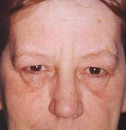 Eye Lift*: Case 4 - Front Before