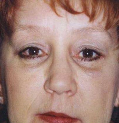 Eye Lift*: Case 4 - Front After