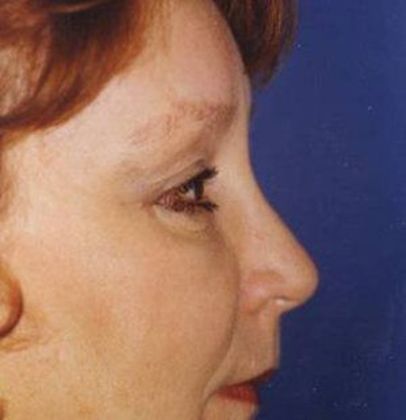 Eye Lift*: Case 4 - Side After