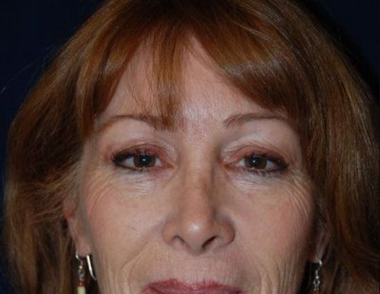 Eye Lift*: Case 5 - Front Before