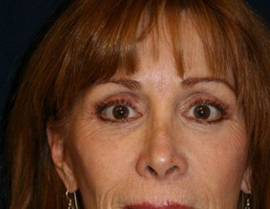Eye Lift*: Case 5 - Front After