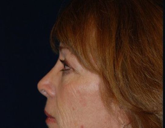 Eye Lift*: Case 5 - Side Before