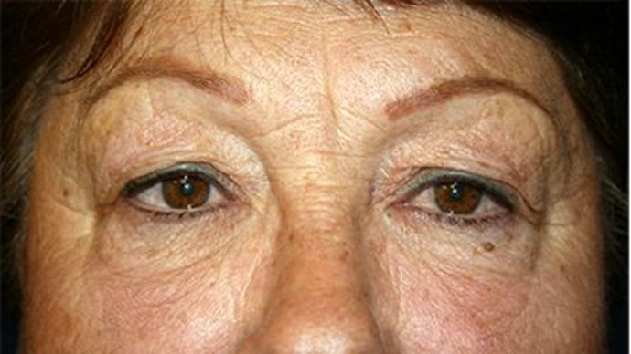 Eye Lift*: Case 7 - Before