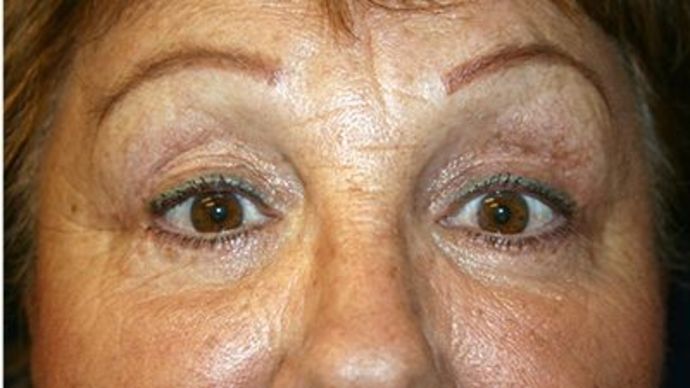 Eye Lift*: Case 7 - After