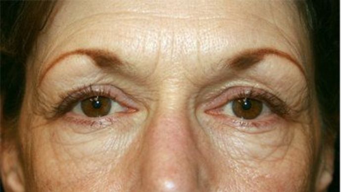 Eye Lift*: Case 8 - Before