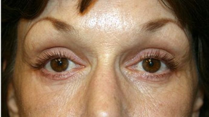 Eye Lift*: Case 8 - After