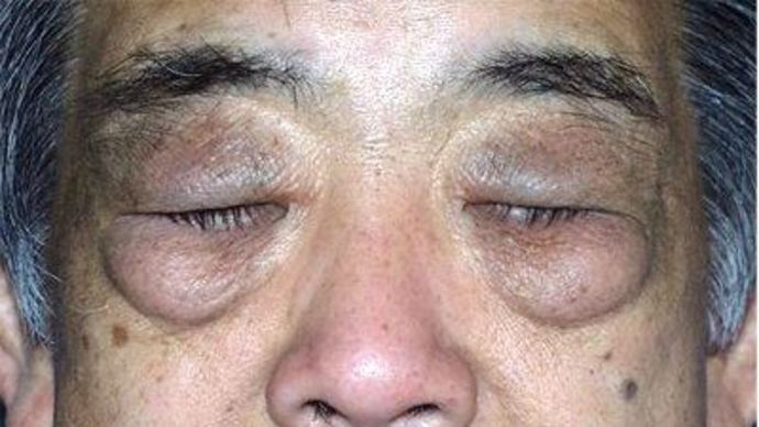 Eye Lift*: Case 9 - Before