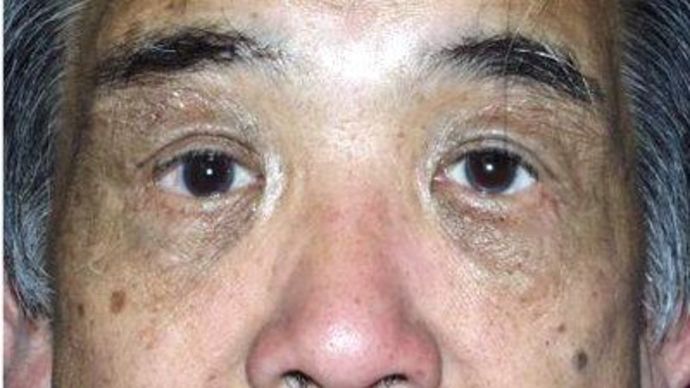 Eye Lift*: Case 9 - After