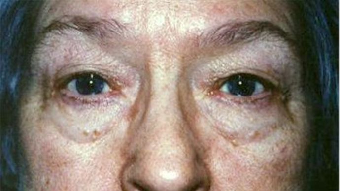 Eye Lift*: Case 10 - Before