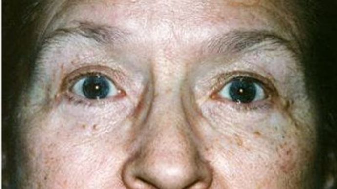 Eye Lift*: Case 10 - After