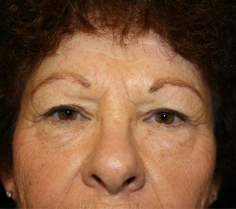 Forehead & Brow Lifts*: Case 1 - Front Before