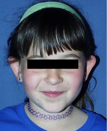 Otoplasty*: Case 1 - Front Before