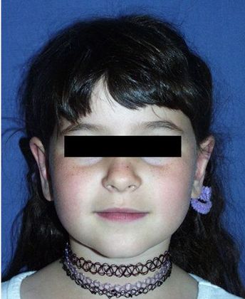 Otoplasty*: Case 1 - Front After