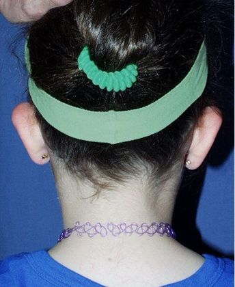 Otoplasty*: Case 1 - Back Before